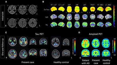 Case report: Non-Alzheimer's disease tauopathy with logopenic variant primary progressive aphasia diagnosed using amyloid and tau PET